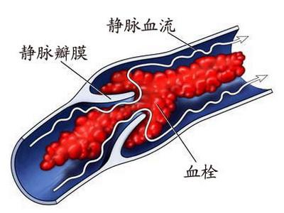 门静脉血栓形成