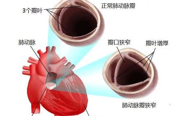 肺动脉狭窄