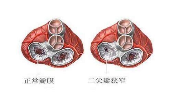 二尖瓣狭窄