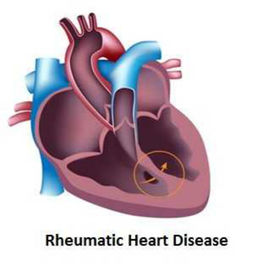 风湿性心脏瓣膜病