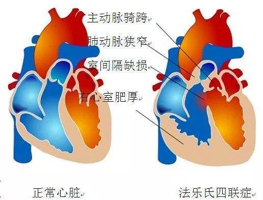 法洛四联症