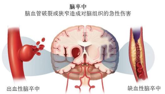 出血性脑卒中