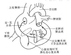 三尖瓣下移畸形