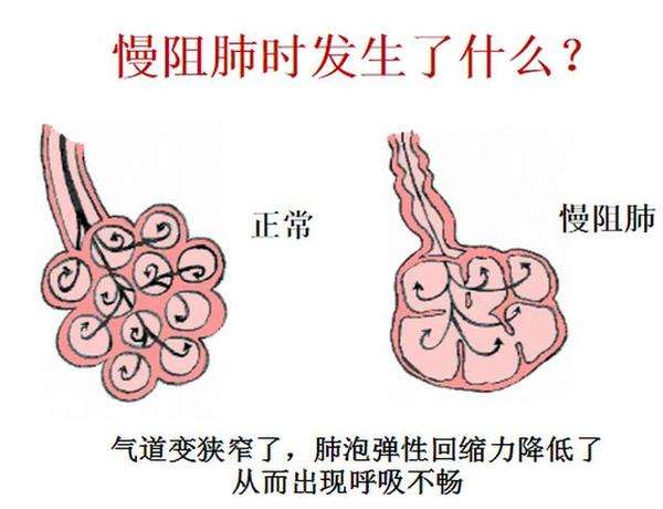 慢性阻塞性肺疾病