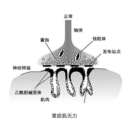 重症肌无力