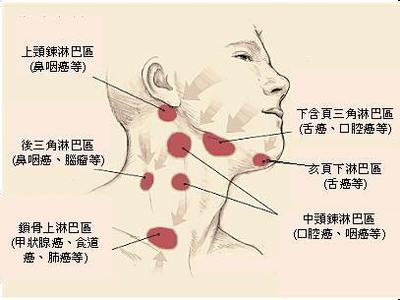 淋巴癌