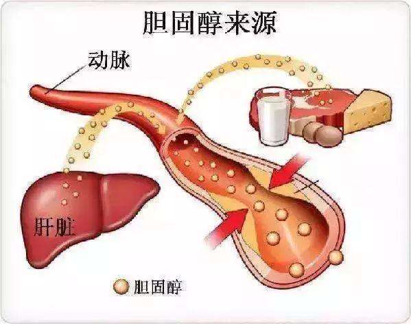 高胆固醇血症