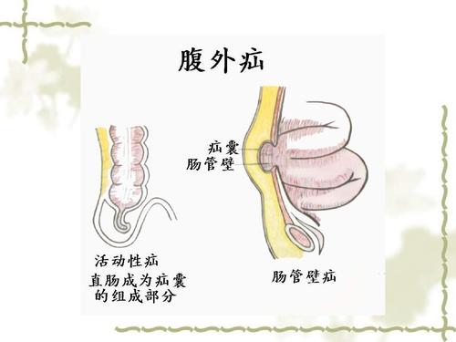 腹外疝