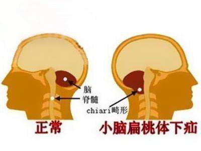 小脑扁桃体下疝