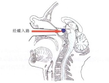 脑脊液鼻漏