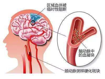 脑动脉硬化