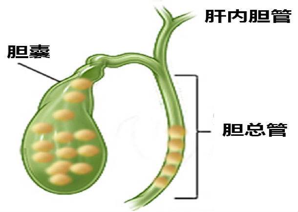 胆管结石