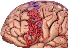 颅内动静脉畸形