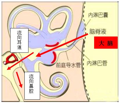 脑脊液耳漏