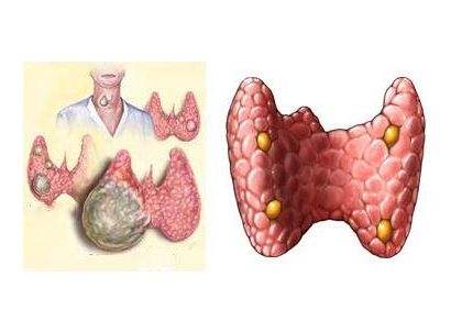 甲状腺囊肿