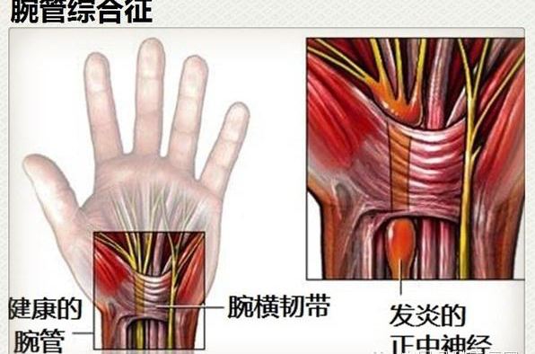 臀肌挛缩症