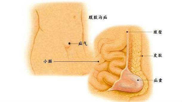 腹股沟疝