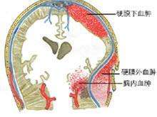 硬脑膜下血肿