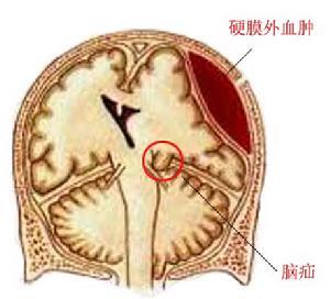 硬脑膜外血肿