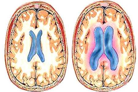 外伤性脑积水