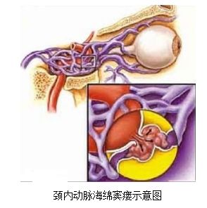 颈动脉海绵窦瘘