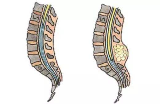 脊髓拴系综合征