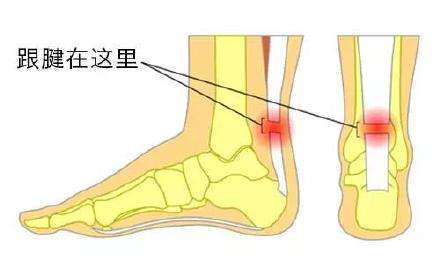 跟腱断裂