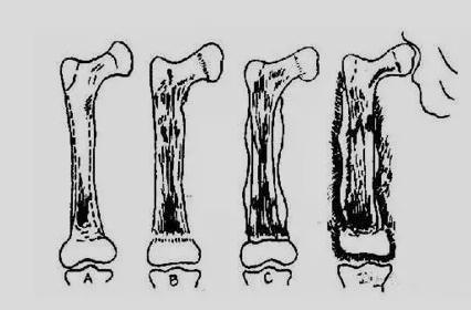 骨髓炎