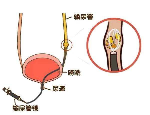 输尿管损伤