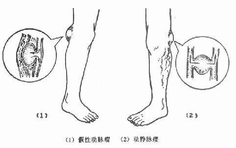 动静脉瘘