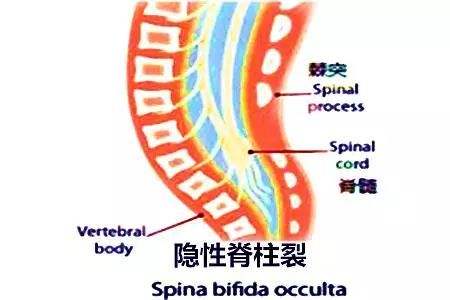 隐性脊柱裂