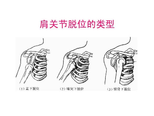 肩关节脱位