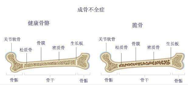 成骨不全