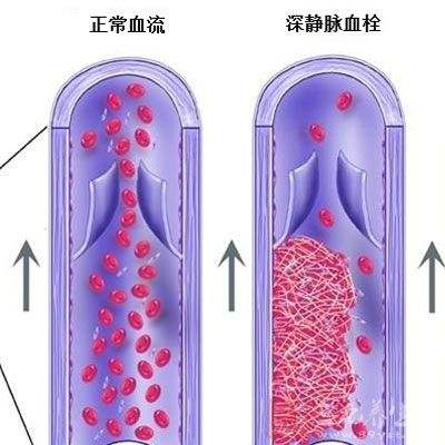 静脉疾病