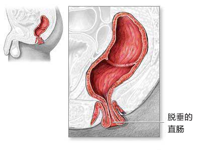 直肠脱垂