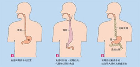 食管息肉