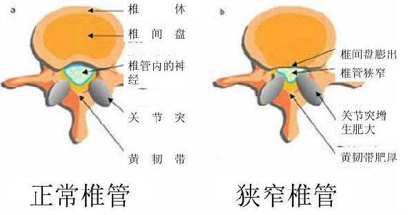 腰椎管狭窄