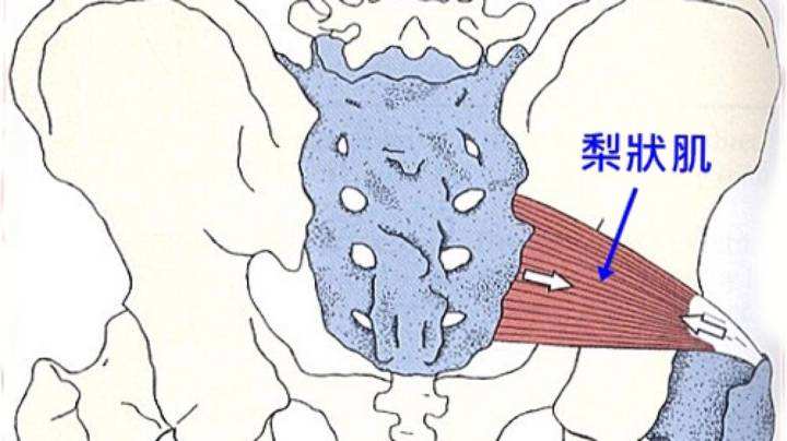 梨状肌综合征