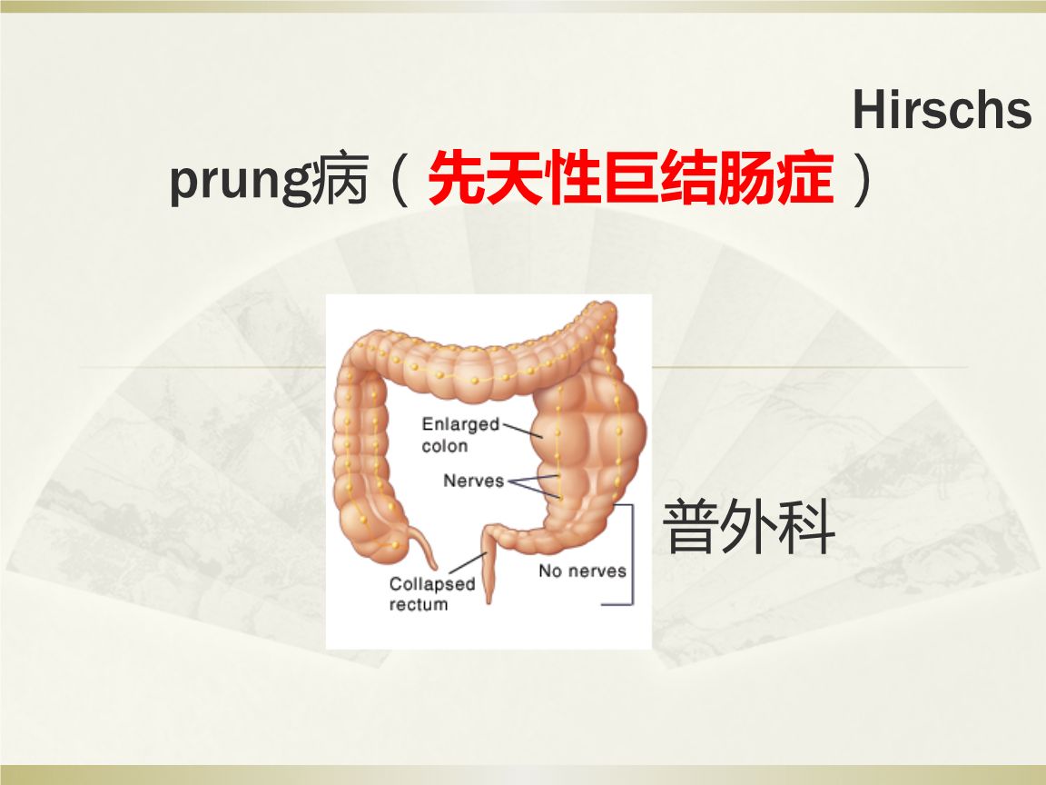 先天性巨结肠