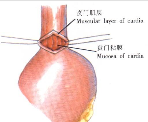 贲门癌