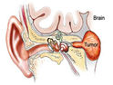 听神经瘤