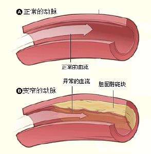 视膜毛细血管前小动脉