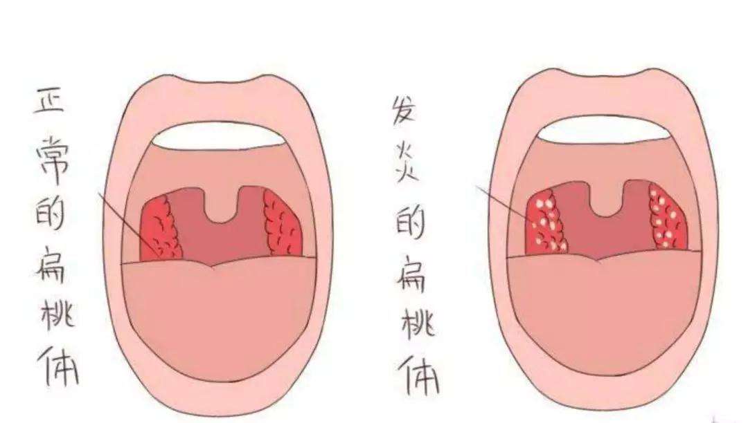 扁桃体恶性肿瘤