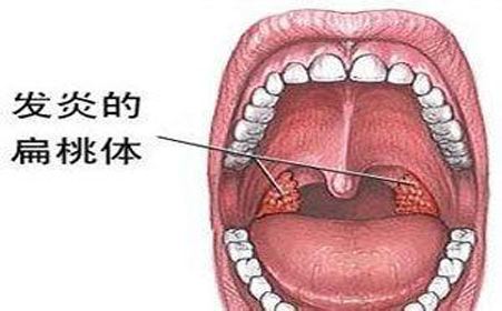 扁桃体癌