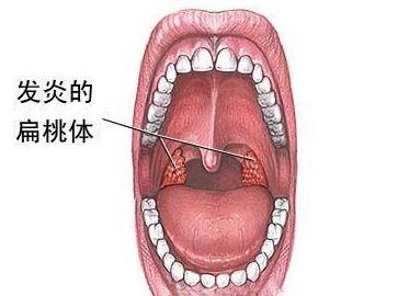 扁桃体炎