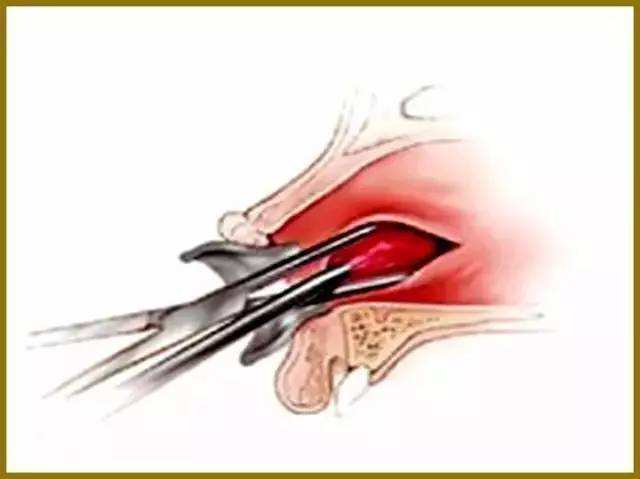 鼻中隔穿孔