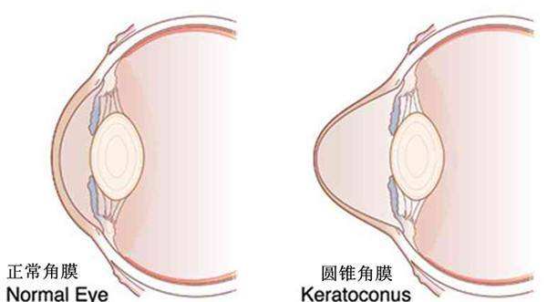圆锥角膜