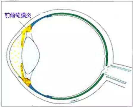 前葡萄膜炎
