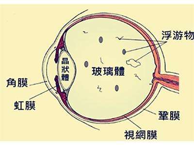 玻璃体后脱离