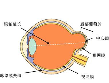 巩膜葡萄肿